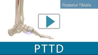 PTTD Relief using the TriLok [upl. by Orgel]