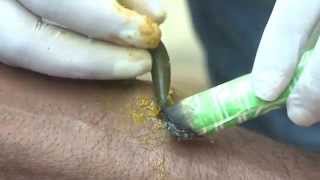 Hirudo Medicinalis Leech Therapy  Nadipathy  Kakinada [upl. by Gerson970]