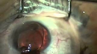 Artificial iris brightocular Aniridia surgery [upl. by Marsha]