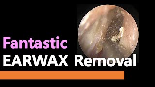 Fantastic huge EARWAX removal [upl. by Naivart847]