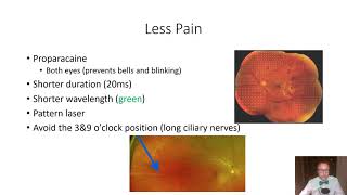 Panretinal Photocoagulation PRP Basics Lumenis Laser  BIDMC  Jamie Raevis Arroyo Gonzalez [upl. by Dnomhcir957]