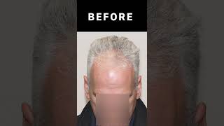 Alma Ted Dutasteride Before and After dutasteride almated mesotherapy hairrestoration Forhair [upl. by Ingold]