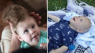 Baby Born with Brain Outside of Skull Gets LifeChanging Surgery [upl. by Ecnaret936]