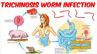 Trichinosis Trichinellosis Worm Infection [upl. by Nunciata]