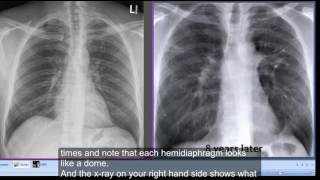 Chest xray Tenting of hemidiaphragms [upl. by Yesteb117]