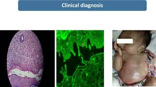 Epidermolysis Bullosa  Spot Diagnosis  9  Pediatrics [upl. by Odnalor510]