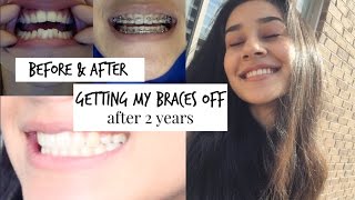 GETTING MY BRACES OFF Before amp After Time Lapse [upl. by Ogires]