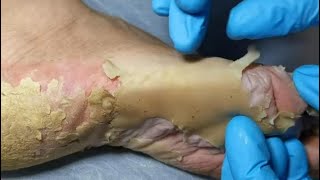 Podiatry  Skin peeling from feet Dead skin removal amp Cracked heels treatment Dry skin treatment [upl. by Garin25]