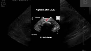 NephrolithBatu Ginjal xray anatomy radiology röntgen batuginjal nephrology ginjal usg [upl. by Suivatra548]