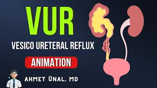 🎬 VUR Vesico Ureteral Reflux CLASSIFICATION amp ANIMATION [upl. by Lowenstern515]