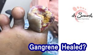 callus Toe Gangrene Before After diabeticfoot toeinfection of big toe [upl. by Everett]