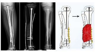 Congenital Pseudarthrosis of Tibia [upl. by Oiramat]