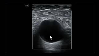 Achados ultrassonográficos e diagnósticos diferenciais da linfocele axilar [upl. by Aihsenet221]