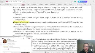 Гистопатологи 4  Nuclear atypia Бөөмийн хэв шинжгүйдэл эсвэл хэв шинжит бус байдал [upl. by Vera994]