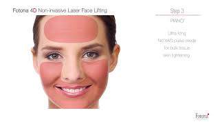 FOTONA Fotona4D® procedure [upl. by Adabelle561]