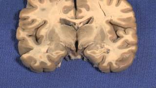 Hypothalamus Neuroanatomy Video Lab  Brain Dissections [upl. by Main564]