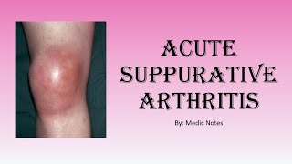 Ortho Acute suppurative arthritisseptic arthritis  clinical feature investigation treatment [upl. by Amos]