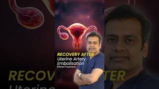 Recovery after Uterine Artery Embolisation  Recovery Time after Uterine Fibroid Embolization UFE [upl. by Nwadahs961]