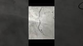 Angioplasty of SVG to PDA Graft with Embolic protection device in post CABG patient after 5 year [upl. by Xer914]