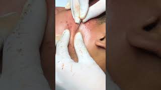 Best Pimple Popping 19beautiful blackheads sacdepspa [upl. by Meelas]