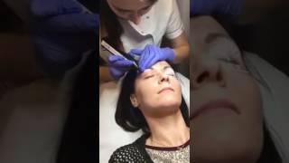 Plasma IQ  korekta powiek w Laser Estetic [upl. by Imiaj]