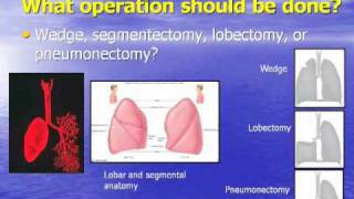 GRACEcast027LungCancerThe Role of Surgery in NSCLC Management [upl. by Traggat]