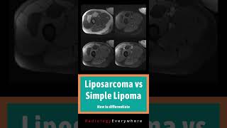 How to differentiate liposarcoma from lipoma  MSK Radiology  1000 cases in 100 days  video 41 [upl. by Remoh]