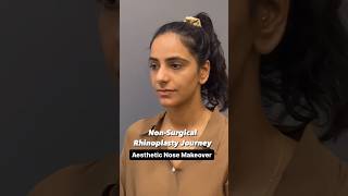 Non Surgical Rhinoplasty Journey  Before amp After Nose Transformation  Cara Clinic Mumbai [upl. by Toby]