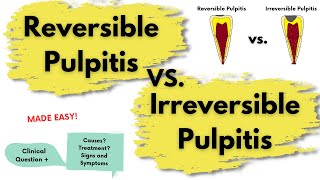 Reversible Pulpitis vs Irreversible Pulpitis  Endodontics [upl. by Zimmermann94]