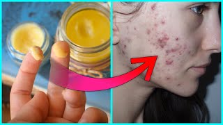 Acne  Pimple को ठीक करें दाग धब्बे और निशान मिटायें  Get Rid of Pimples Acne Naturally [upl. by Rodriguez]