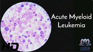 Acute Myeloid Leukaemia Everything You Need To Know [upl. by Mab755]