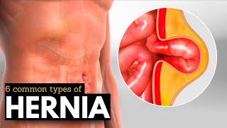 Hernia Breakdown Discovering the 6 Most Prevalent Types [upl. by Wieche]