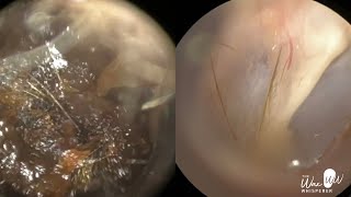 157  Severe Ear Wax Extraction From Difficult Twisty Ear using the WAXscope®️ [upl. by Annuhsal69]