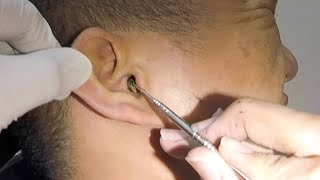 One Hard Earwax Removed form Mans Ear [upl. by Jarl]