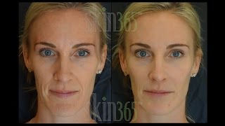 Radiesse quotDermal Fillerquot immediate results and stimulates collagen to grow [upl. by Weinert]