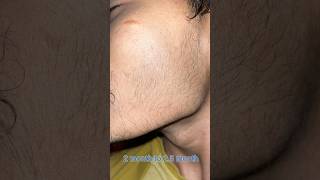 minoxidil minoxidil beard growth  2 month minoxidil beard  mintop [upl. by Imogen30]