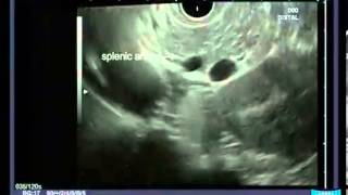 Radial Endoscopic Ultrasound  Anatomical Guiding Structures in the Upper Abdomen [upl. by Yretsym]