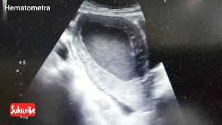 Ultrasound video showing Hematometra [upl. by Notlih]