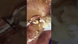 Remove ACNE FAST With These Treatment Secrets110 dermatologia acne blackheads pimple [upl. by Ydac868]