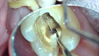 Mesial distal crack  Split tooth [upl. by Amy]