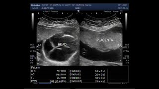 Fetal Hydrocephalus with Pregnancy of about 19 weeks [upl. by Anirrehs367]