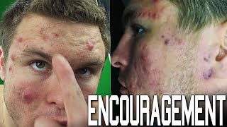 Encouragement for People Suffering With Acne [upl. by Amiarom]