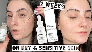 TESTING THE ORDINARY HYALURONIC ACID ON DRY SENSITIVE SKIN FOR 2 WEEKS IN A DRY CLIMATE [upl. by Ternan439]