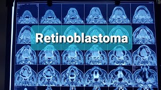 Retinoblastoma Orbital tumors Classification [upl. by Venetis818]