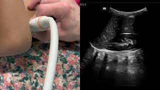 Pediatric RenalBladder Scan Demo R kidney long axis [upl. by Wilt]