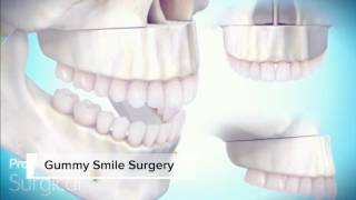 Gummy Smile Surgery [upl. by Stafani]