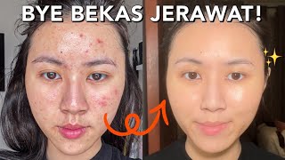 CARA MENGHILANGKAN BEKAS JERAWAT PIH TANPA SKINCARE  Bye bekas jerawat dan kulit kusam [upl. by Florentia]