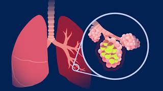 Understanding Pneumococcal Pneumonia [upl. by Ardnama]