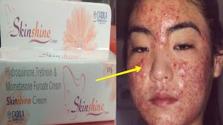 Skin Shine CREAM SIDE EFFECTS के कारण  Reason of SIDE EFFECTS  How to Remove side effects  Hindi [upl. by Acissej460]