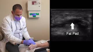 PRP in Plantar Fascia with Ultrasound Guided Tibial Nerve Block 1 CME David Rosenblum MD [upl. by Kcinomod]